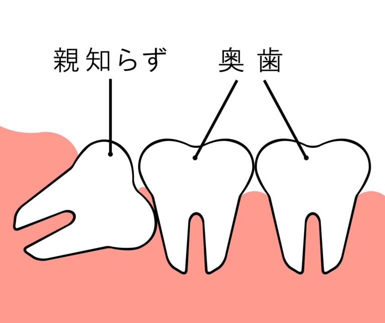 親知らずの抜歯