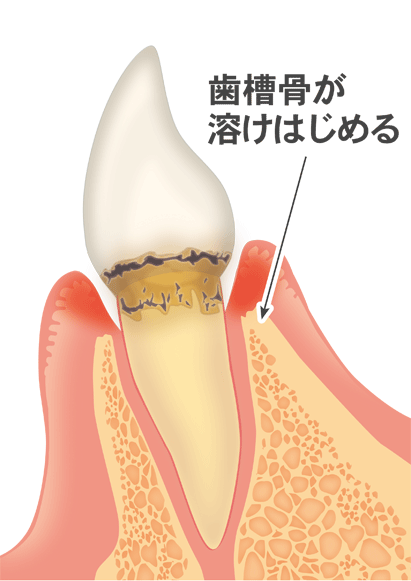 歯周病（軽度）