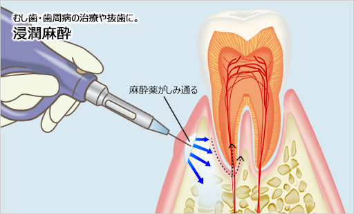 電動麻酔注射器